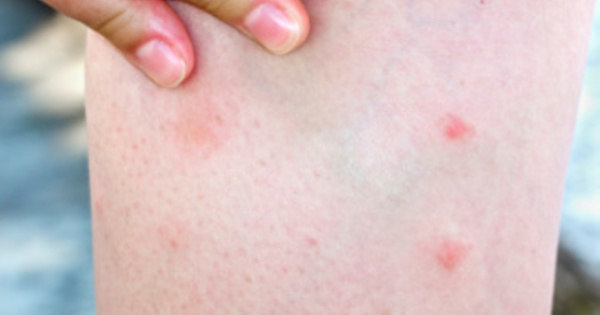 Picada do Aedes aegypti não coça e nem deixa marcas: saiba tudo sobre o ...