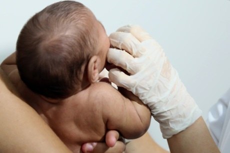 Bebês com microcefalia sofrem diversos problemas de saúde