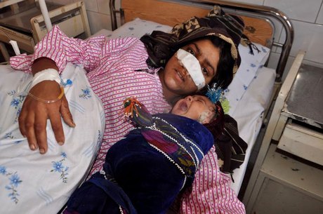 Mulher tem o nariz arrancado pelo marido no Afeganistão 
