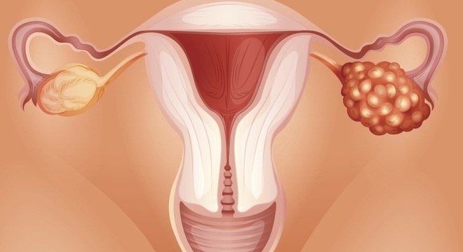 Menstruação retrógrada: saiba o que é e qual doença ela pode causar