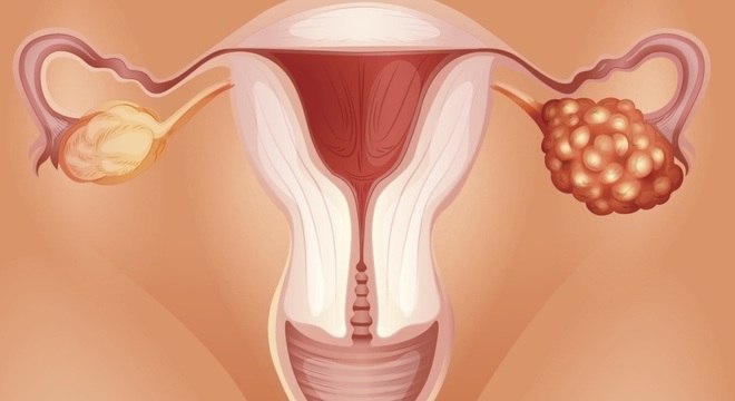 A endometriose pode causar lesões nos ovários e nas trompas, impedindo a mulher de engravidar