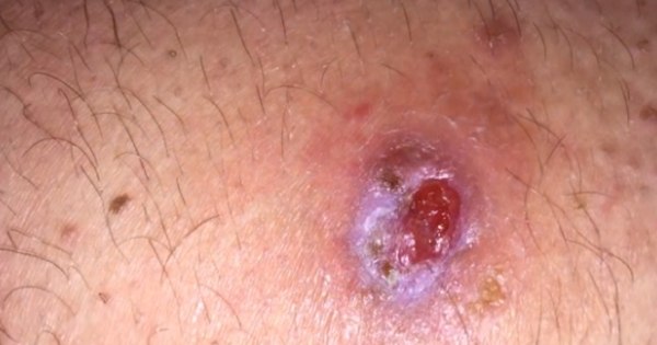 Imagens chocantes! Picada de aranha deixa buraco sinistro e nojento na