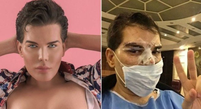 Apos Cirurgia No Nariz Ken Humano Brasileiro Contrai Bacteria Comedora De Carne Entretenimento R7 Famosos E Tv