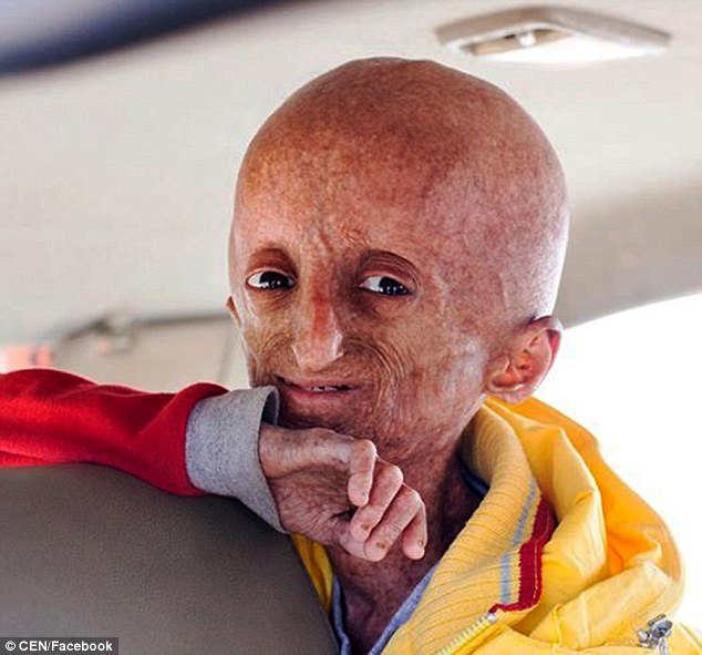 Doenca Rara Progeria