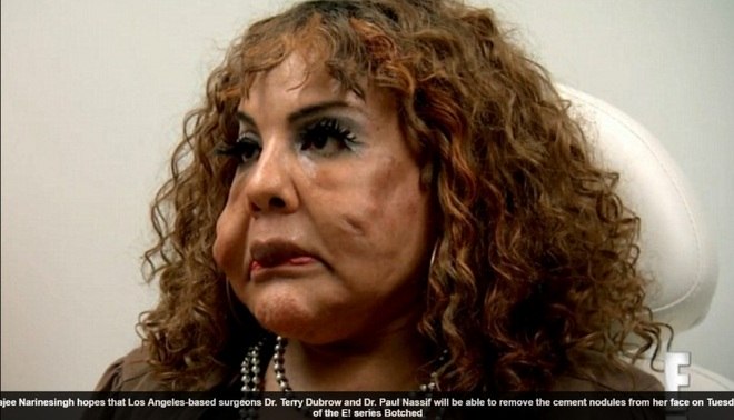 Desesperada por estar com rosto deformado, a transexual Rajee
Narinesingh, de 48 anos, implora ajuda médica para remover os caroços que se
formaram em suas bochechas