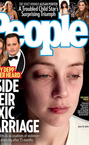 Amber Heard aparece com novos hematomas em fotos inéditas Amber Heard aparece com novos hematomas em fotos inéditas