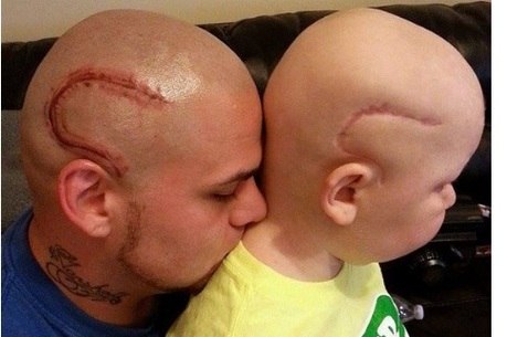 Pai tatua a cicatriz na cabeça para ficar igual ao filho