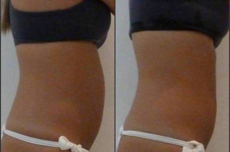 DLA Reduz garante 8 centímetros a menos na região abdominal em uma sessão DLA Reduz garante 8 centímetros a menos na região abdominal em uma sessão