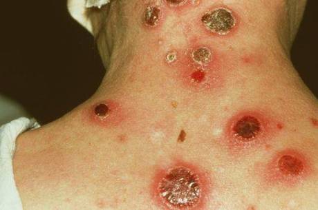 Cancros são um dos sintomas da doenças, mas seu desaparecimento não indica cura
Cancros são um dos sintomas da doenças, mas seu desaparecimento não indica cura