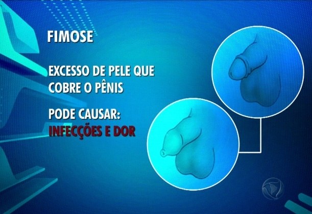 Saiba Os Riscos Da Cirurgia De Fimose Que Amputou Crianca De 3 Anos Noticias R7 Saude