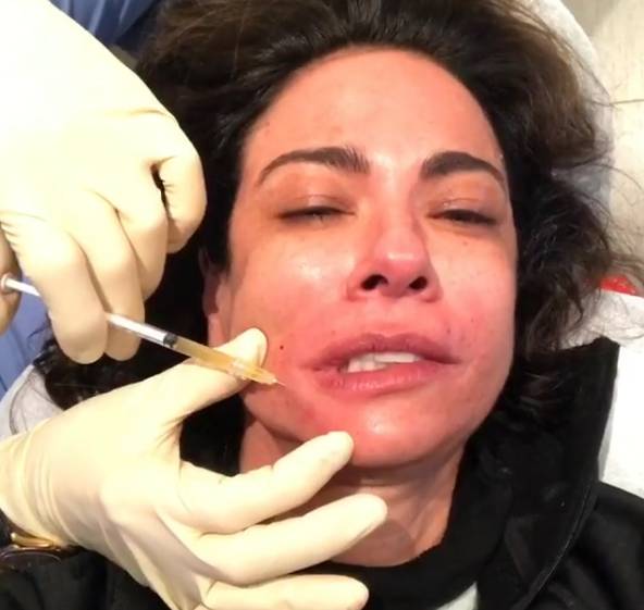 Luciana Gimenez repete procedimento estético que usa o próprio sangue como  tratamento de beleza; assista! - Entretenimento - R7 Famosos e TV