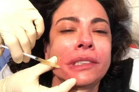Luciana Gimenez repete lifting de vampiro feito em 2014