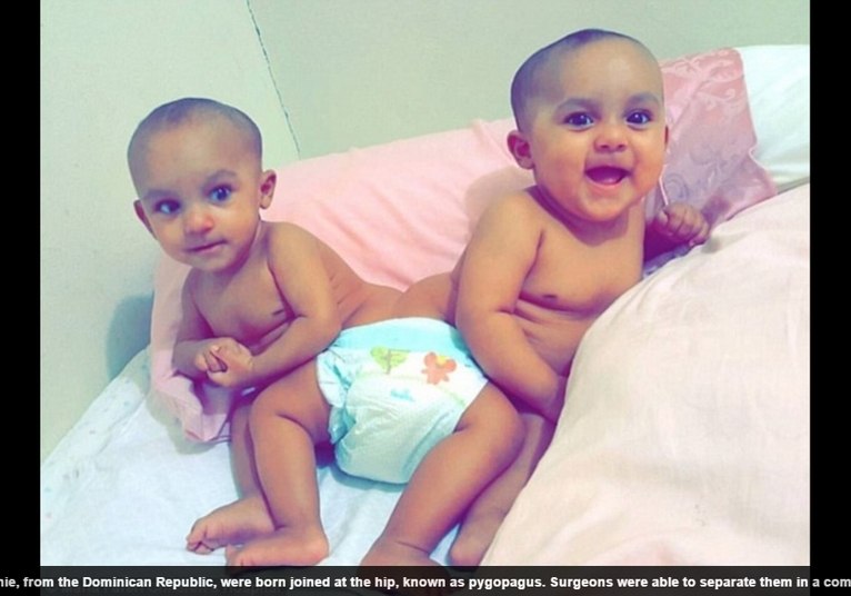 As gêmeas Bellanie e Ballanie Camacho, da República Dominicana, nasceram unidas pelo quadril no dia 4 de fevereiro de 2016. Elas dividiam intestino, bexigas, sistema reprodutor e a parte inferior da medula espinhal. As informações são do Daily Mail