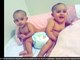 As gêmeas Bellanie e Ballanie Camacho, da República Dominicana, nasceram unidas pelo quadril no dia 4 de fevereiro de 2016. Elas dividiam intestino, bexigas, sistema reprodutor e a parte inferior da medula espinhal. As informações são do Daily Mail