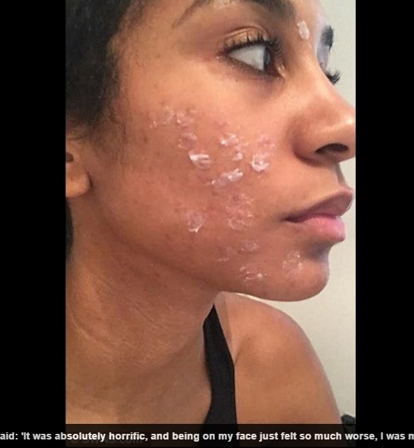 Noiva fica com cicatrizes após alergia a cera depilatória "Meu rosto