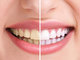 Ter os dentes saudáveis faz toda a diferença na hora
de abrir aquele sorrisão. Mas, e quando você escova os dentes após as
refeições, usa fio dental e ainda assim o sorriso fica amarelado? 

De acordo com a dentista e especialista em
dentística estética Elaine Cristina de Almeida, a causa pode estar nos
alimentos ácidos ou naqueles com forte pigmentação, conhecidos como
cromogênicos.<br><br>A especialista ressalta que não é necessário ser radical e parar de
ingerir esses alimentos.<br><br>
— A melhor solução é não exagerar e sempre escovar
os dentes depois de consumi-los. Se não for possível, recorra a um copo d’água