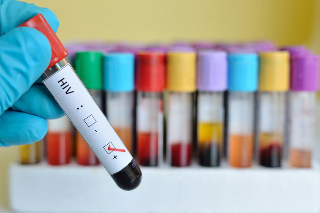 Apesar da evoluÃ§Ã£o nas formas de tratamento e prevenÃ§Ã£o, a Aids (sÃ­ndrome da imunodeficiÃªncia adquirida), continua a ser uma preocupaÃ§Ã£o da populaÃ§Ã£o mundial e de saÃºde pÃºblica. Segundo dados do Unaids (Programa Conjunto das NaÃ§Ãµes Unidas), 14 mil pessoas morreram no Brasil em decorrÃªncia do vÃ­rus HIV, em 2016.Â  A organizaÃ§Ã£o ainda estima que 830 mil pessoas vivem com a doenÃ§a no PaÃ­s, sendo que o Brasil Ã© o que mais concentra novos casos de infecÃ§Ãµes na AmÃ©rica Latina (49%). Mesmo sendo mundialmente conhecida, a Aids ainda causa muitas dÃºvidas. Por isso, a professora do Departamento de SaÃºde Coletiva da FCMSCSP (Faculdade de CiÃªncias MÃ©dicas da Santa Casa de SÃ£o Paulo), Maria AmÃ©lia de Sousa Mascena Veras esclarece mitos e verdades sobre a sÃ­ndrome. Veja a seguir:Â 