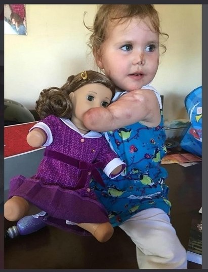 Uma menina de três anos deu seus primeiros passos com
próteses e um andador após a perda de suas pernas e braços por causa de uma
meningite