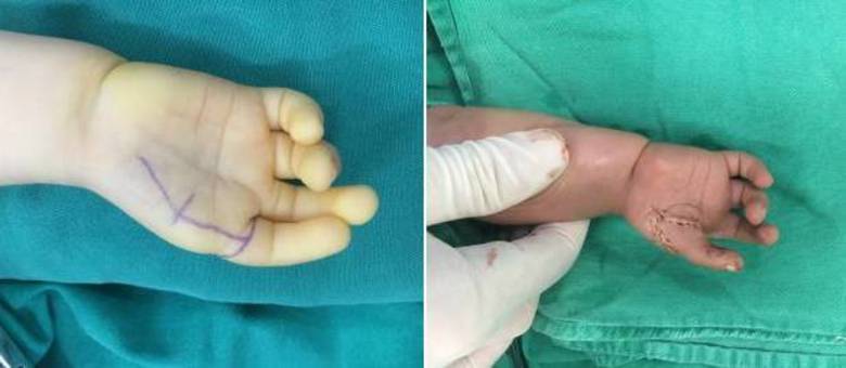 Acima, a mão da criança antes e após a operação de transformação do indicador em polegar
