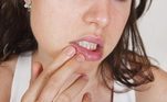 AIDS É comum que a primeira manifestação da doença ocorra na boca, pois patologias causadas por bactérias, fungos ou vírus, atacam o sistema imunológico do paciente. Gengiva inflamada, candidíase (placas brancas que podem ser removidas com a raspagem), placas ou linhas verticais brancas na região lateral da língua, e feridas (aftas maiores) nas mucosas internas, língua, gengiva, amígdalas e lábios são os alguns dos sintomas