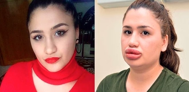 Merve vai ter que ser operada, segundo o tabloide Daily Star, ainda nesta semana. A correria é para tentar corrigir o erro 