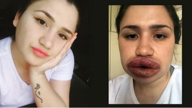 Mas o barato acabou saindo MUITO caro. A boca infeccionou e o estrago foi grotesco. Seus lábios incharam e ficaram cada vez maioresE você já se inscreveu no canal do Hora 7 no YouTube? Tá esperando o quê?