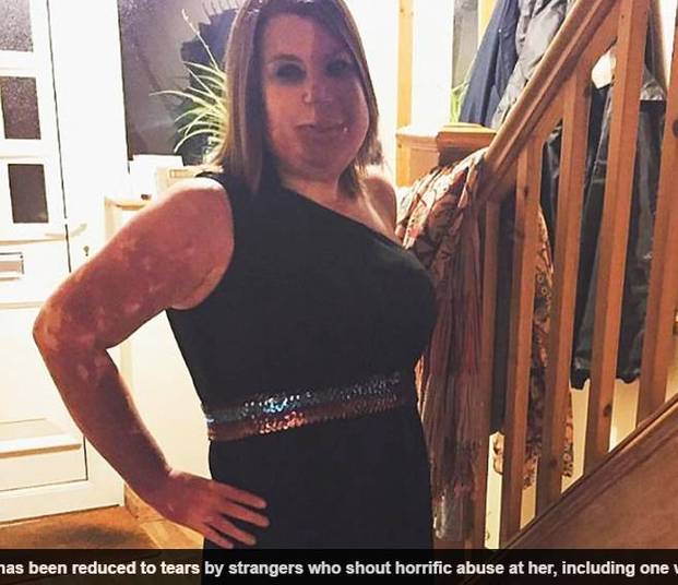 Passados anos, Sharon superou a insegurança e diz que
não mudaria nada em seu corpo porque a marca de nascença a faz ser única.
— As pessoas não percebem o que suas palavras
realmente significam. É ainda mais compreensivo quando as pessoas me dizem que
sou corajosa, mas não sou corajosa. Pessoas que sofrem queimaduras e ficam
desfiguradas são corajosas. Eu só tenho uma marca de nascença