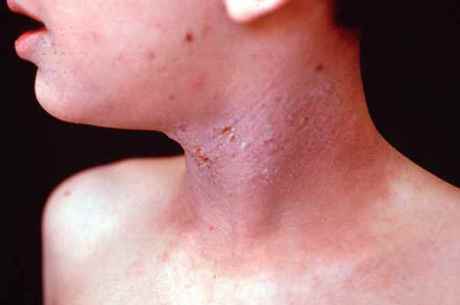 A dermatite atópica acomete cerca de 40 milhões de brasileiros