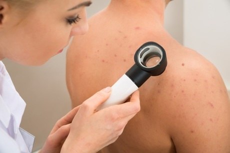Visitas periódicas ao dermatologista garantem detecção precoce do melanoma