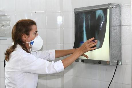 Levantamento destaca a necessidade de os governos aumentarem os esforços de combate à tuberculose que, em 2015, matou 1,8 milhão de pessoas no mundo- Agecom Bahia