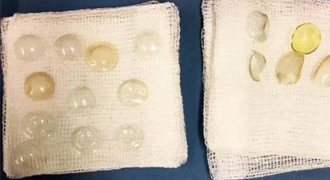 Paciente acumulou lentes de contato nos próprios globos oculares por mais de 20 anos; médicos se chocaram Paciente acumulou lentes de contato nos próprios globos oculares por mais de 20 anos; médicos se chocaram