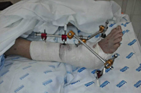 Perna direita da criança atropelada por GCM após a primeira cirurgia Perna direita da criança atropelada por GCM após a primeira cirurgia