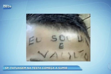 Rapaz Que Teve Testa Tatuada Passa Por Segunda Fase De Remocao Noticias R7 Sao Paulo