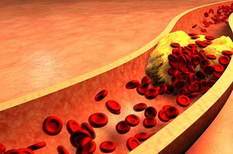 Colesterol alto pode levar a enfarte e AVC