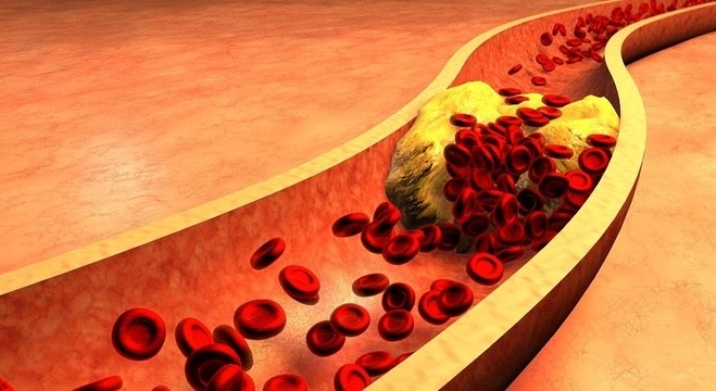 Alto índice de colesterol leva ao entupimento de artérias 