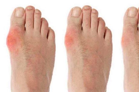Dicas para acabar com as joanetes