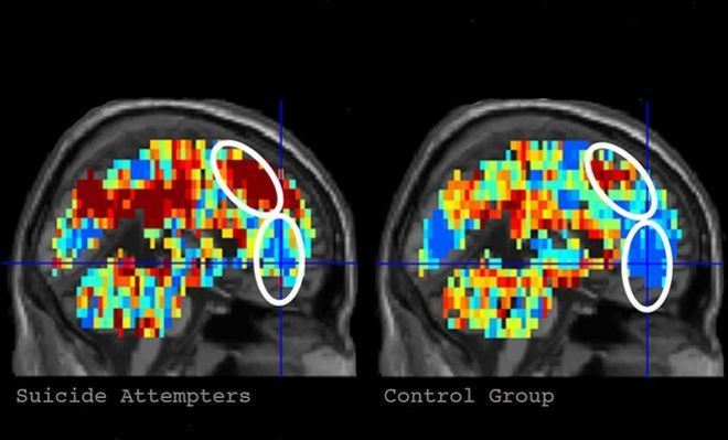 Inteligência artificial na saúdeCom a ajuda de algoritmos complexos e redes neurais, a inteligência artificial aprendeu a “ver” e distinguir objetos. Ao analisar milhões de fotos de uma bicicleta, por exemplo, uma IA pode reconhecer o objeto. Usando a mesma técnica, um computador pode apontar com alto índice de acerto sinais de doenças em imagens médicas. Algoritmos podem, por exemplo, identificar tendências suicidas