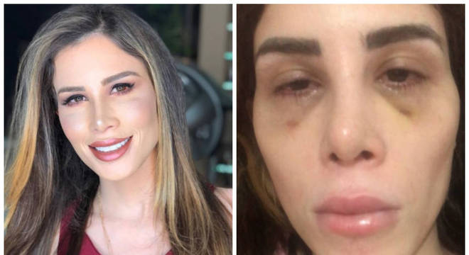 Camilla Uckers antes e depois da infecção generalizada Camilla Uckers antes e depois da infecção generalizada
