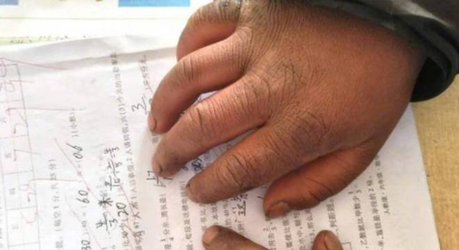 Foto mostra que Wang recebeu nota 99 em um teste, apesar das mãos sujas e inchadas Foto mostra que Wang recebeu nota 99 em um teste, apesar das mãos sujas e inchadas