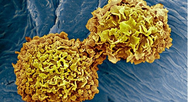 Método detecta, a partir do exame de sangue, oito tipos de proteínas e 16 mutações genéticas comuns em quem já foi diagnosticado com câncer