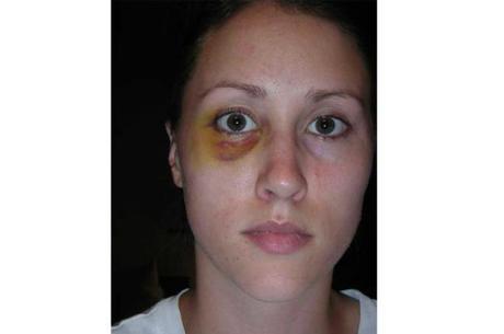 Colbie Holderness com o olho roxo após levar soco do ex-marido