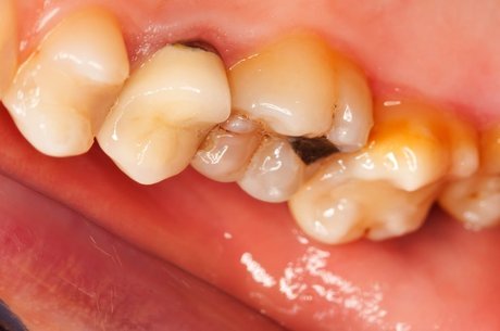 Erosão dentária pode causar perda de dentes 