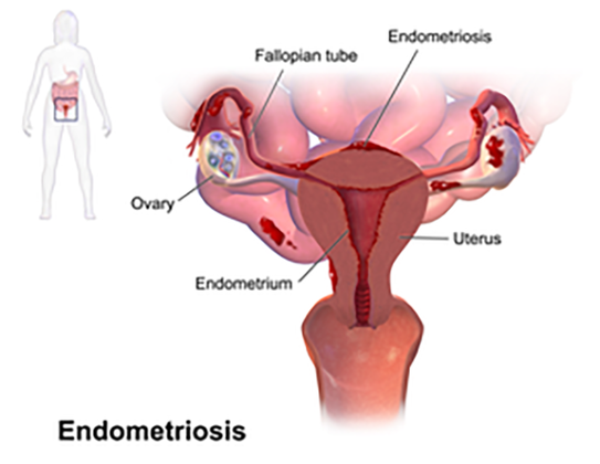 A endometriose é uma doença que atinge cerca de 10% das mulheres brasileiras e que pode levar a complicações se não for tratada de forma adequada. 