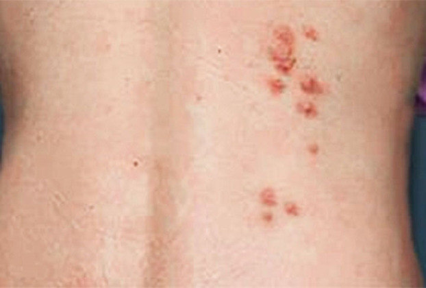 A principal consequência é a coceira intensa, com manchas vermelhas na pele. A reação pode demorar até dez dias para aparecer, o que dificulta o diagnóstico.