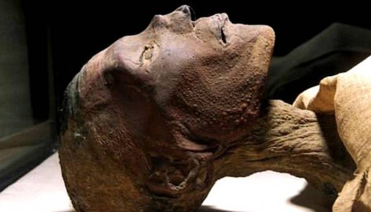 A varíola fez vítimas no Antigo Egito. A múmia de Ramsés V - morto em 1.156 a.C - trazia cicatrizes típicas da doença. 