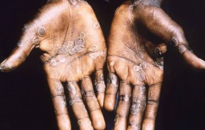 A varíola humana é uma das doenças mais mortais da história e remonta a 10 mil anos. Teria surgido nos primeiros agrupamentos agrícolas, no nordeste da África. 