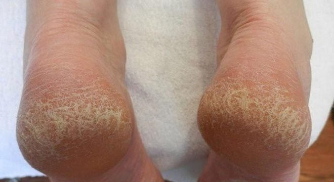 A verdade por trás do calcanhar de maracujá - O que é? Tem cura?