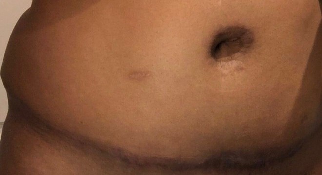 Além da cicatriz, Tatiana não ficou satisfeita com sobra de pele da lateral do corpo