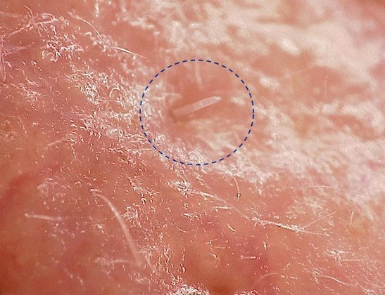 Quando você vai dormir, a agitação dos ácaros começa: esses animais minúsculos aproveitam o sono humano para se reproduzir no rosto. Mas o conforto da nossa cara é tão grande que algumas espécies estão se tornando muito dependentes da pele humana. A ponto de poderem ser extintas. 