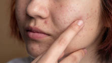 Pessoas com acne enfrentam preconceitos que prejudicam vida social e profissional, mostra estudo